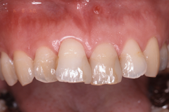 前歯の矯正とオールセラミック治療