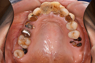 虫歯で歯がボロボロの状態（上顎）