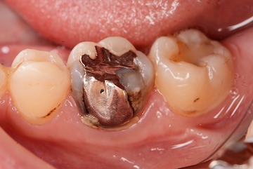 銀歯の隙間から虫歯が再発