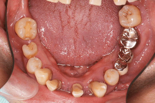 重度歯周病の症例病