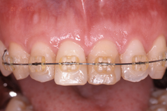 前歯の矯正とオールセラミック治療