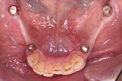 インプラントを用いた義歯症例