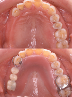 インプラントを用いた義歯症例