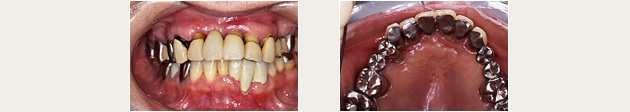 義歯症例