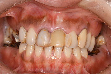 虫歯で歯がボロボロの状態（正面）