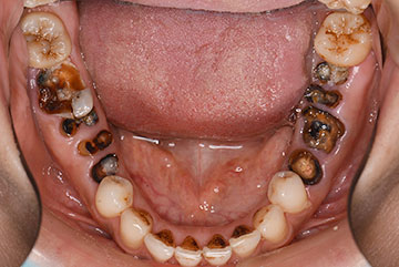 虫歯で歯がボロボロの状態（下顎）