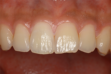 前歯の矯正とオールセラミック治療