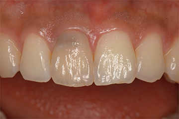 前歯の矯正とオールセラミック治療