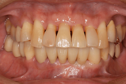 重度歯周病の症例