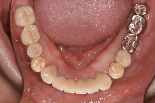 重度歯周病の症例病