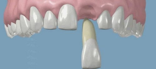 意図的歯牙再植術（歯の再植）