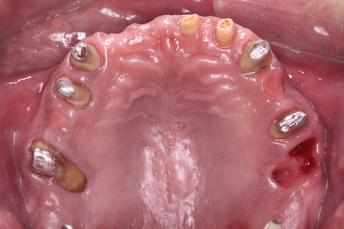 上部構造を外し、保存不可な歯牙を抜歯した状態