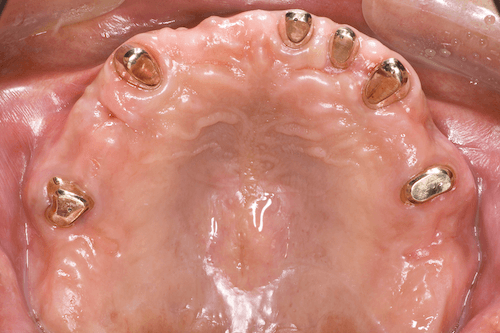 義歯の支台歯となる部分に内冠を装着した状態例