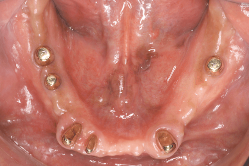 義歯の支台歯となる部分に内冠を装着した状態