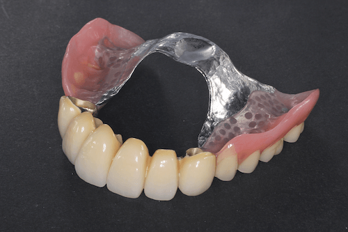 コーヌステレスコープ義歯（上顎）