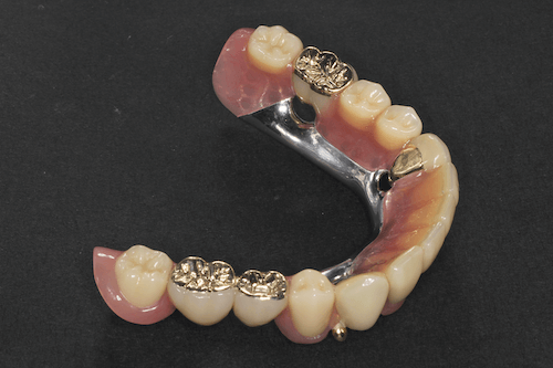 コーヌステレスコープ義歯（下顎）