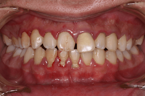 軽度歯周炎の写真