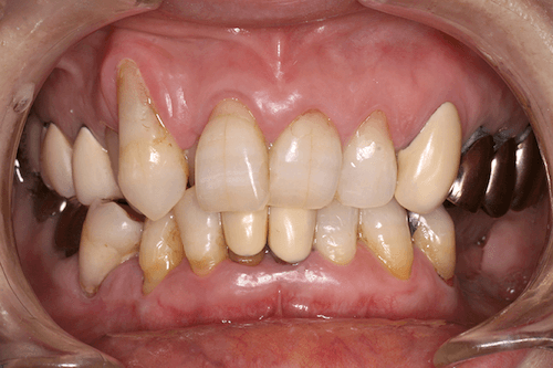 重度歯周炎の写真