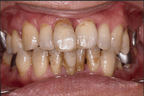 中等度歯周炎の写真