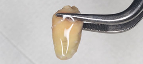 意図的歯牙再植術（歯の再植）